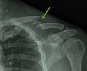Clavicola fragment